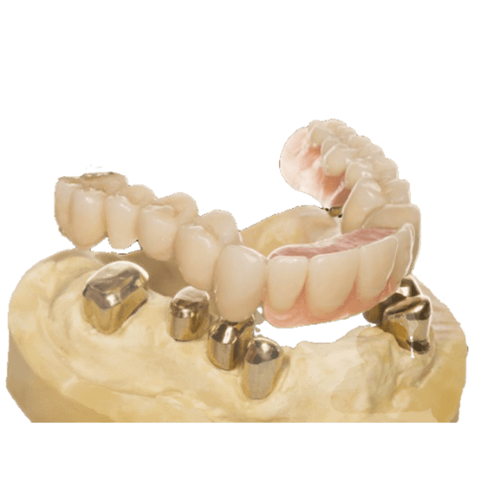 Teleskopprothese